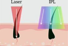 IPL vs. Laser