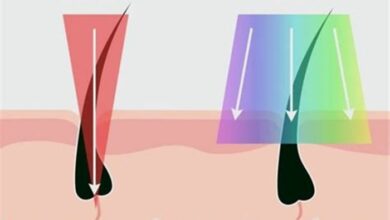 IPL vs. Laser